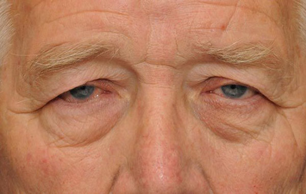 Top 5 cách chữa sụp mí mắt tự nhiên 1