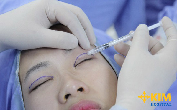 Phẫu thuật cắt mí mắt trên được nhiều người ưa chuộng 3