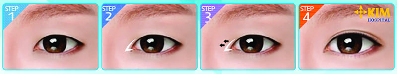 Thẩm mỹ mắt to cải thiện mắt xếch hiệu quả 1